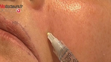 Du Botox® pour combattre le cancer de l'estomac&nbsp;?