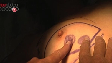 Cancer du sein : pas de meilleure survie avec une double mastectomie