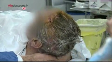 Implantation d'un dispositif de stimulation électrique à fréquence élevée. Attention images de chirurgie impressionnantes ! Chirurgie de stimulation cérébrale