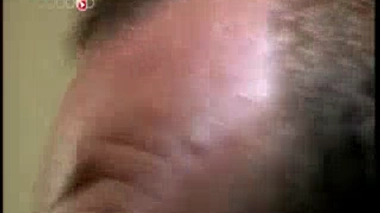 Plus de cancers agressifs de la prostate chez les chauves ?