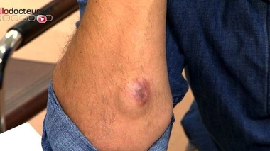 Kystes sous-cutanés : un retrait chirurgical