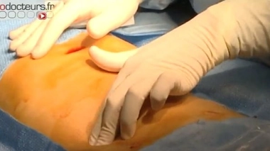 Diabète : inquiétudes face à l'arrêt de la production d'une pompe à insuline