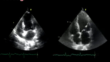Infarctus : une prise de sang pour évaluer les risques de rechute
