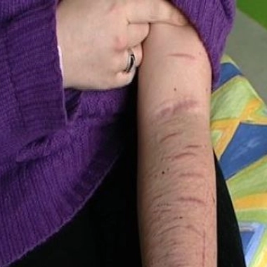 Automutilation : des ados en souffrance