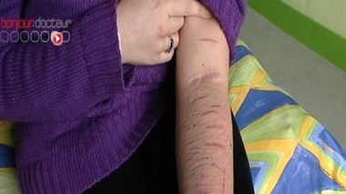 Automutilation : des ados en souffrance