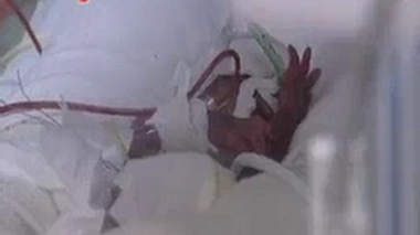 Prématurité légère : des risques avérés	