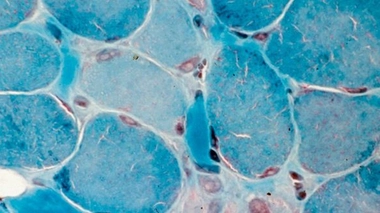 Lésion et régénération cellulaires dans la maladie de Duchenne © Inserm