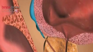 Cancer agressif de la prostate : intérêt confirmé du traitement de référence