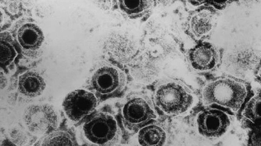Virus Herpes Simplex