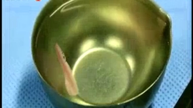 Des cellules souches embryonnaires pour soigner l'infarctus