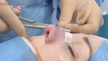 Rhinoplastie : le nez remodelé