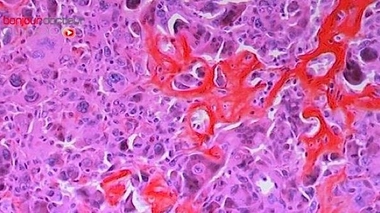 Le cancer est la maladie qui effraie le plus les Français