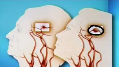 Ch@t : Les accidents vasculaires cérébraux