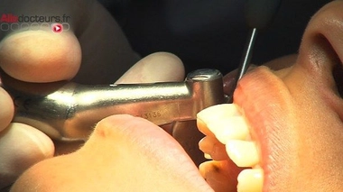 Des milliards de caries ne sont jamais soignées