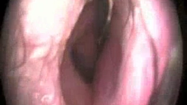 Attention, ces images médicales peuvent être choquantes. Vidéo : Examen endoscopique du patient brésilien (source - NEJM / crédits - A.F.B. Marco & M.D Baptista) - Illustration : une larve de Lucilie bouchère (cliché : John Kucharski, USDA, 2006)