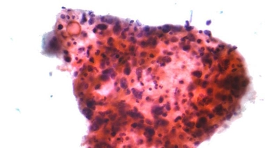 Micrographie d'un carcinome à cellules squameuses, un type de cancer non à petites cellules. (cc by-sa Nephron)