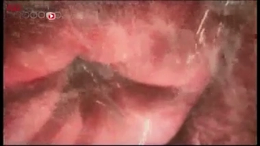 Vidéo : reportage diffusé le 10 mai 2015, à l'occasion de l'annonce des premiers résultats. Image d'illustration : des spermatozoïdes (DR).