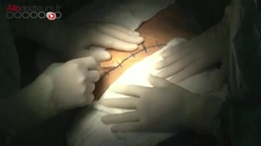 La greffe de foie à partir d'un donneur vivant.