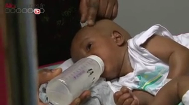 Des frères siamois guinéens séparés à l'hôpital Necker - Enfants malades, à Paris. Attention, images de chirurgie.
