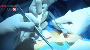 Étape d'une procédure de greffe de tissu ovarien (image d'archive). 