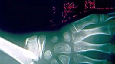 Ch@t : Les fractures