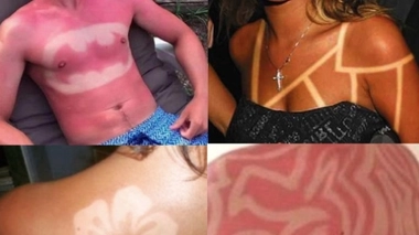 Les tatouages coups de soleils, une pratique dangeureuse. Montage twitter.