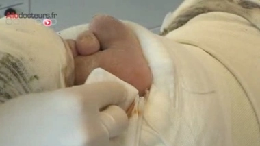 Les ultrasons ont permis d'accélérer le temps de cicatrisation des plaies chorniques de 30%.