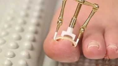 Le Makizume Robo permettrait de soigner les ongles incarnés en 30 minutes (Capture d'écran YouTube). 