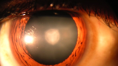 Une nouvelle stratégie pour traiter la cataracte infantile