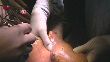 Greffe de foie (Image d'illustration)