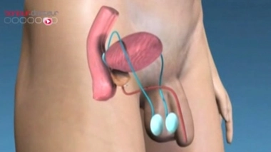 A partir de l'analyse génétique des cellules cancéreuses, les scientifiques ont distingué cinq types différents de cancer de la prostate.