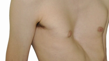 Pectus excavatum : la poitrine creuse