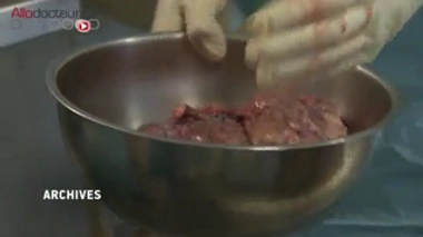 Six des huit personnes contaminées par l'hormone de croissance avaient également des signes d'Alzheimer précoce (Image d'illustration)