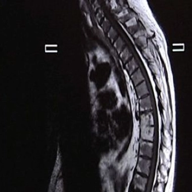 Spondylarthrite ankylosante, la soudure osseuse des articulations
