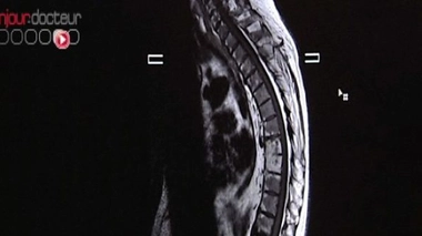 Spondylarthrite ankylosante, la soudure osseuse des articulations