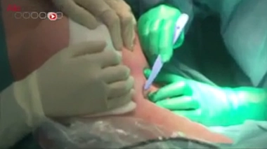 Cancer du sein : des tests pour éviter les chimiothérapies inutiles