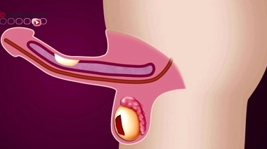 Maladie de Lapeyronie : le point sur les traitements