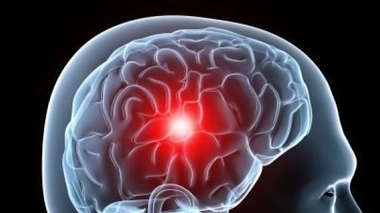 Le cerveau et l'AVC. Crédit Somedical