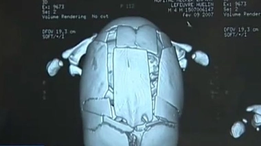 Ch@t : Les traumatismes crâniens