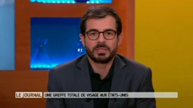 Patrick Hardison, avant l'opération, et trois mois après l'opération (crédits photo : centre de recherche médicale NYU Langone de New York)