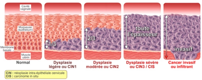 Quels sont les différents stades des lésions dues à des HPV ? (Image ©Papillomavirus.fr)