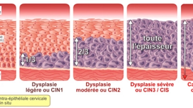 Quels sont les différents stades des lésions dues à des HPV ? (Image ©Papillomavirus.fr)