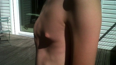 Pectus carinatum : le thorax saillant