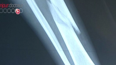 CrAAAc : c'est une fracture !