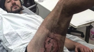 La batterie de son iPhone explose et lui brûle la jambe - Crédit photo : Gareth Clear via Storyful  