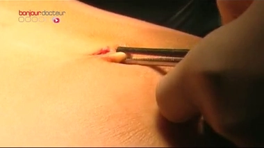 Greffe : une première européenne à Lyon