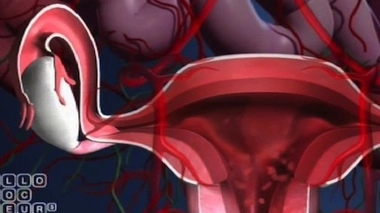 Greffe d’utérus : les États-Unis aussi