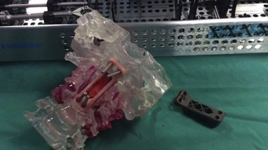 À gauche, la prothèse métallique. À droite, une pièce "modèle" servant aux chirurgiens pour s'entraîner à l'opération. (crédits : R. Mobbs)le cle