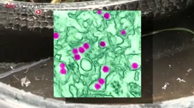 Zika et syndrome de Guillain-Barré : le lien se confirme