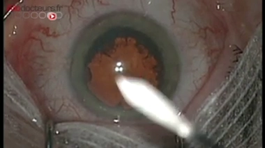  La check-list a du mal à s'imposer dans les blocs opératoires (sujet du 9 mars 2016). 